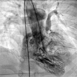 Cine Angiogram Of Patient A On Right Ventricular Injection In The