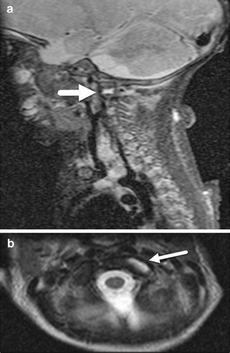 Capsular Injury In A Month Old Boy With Abusive Head Trauma A