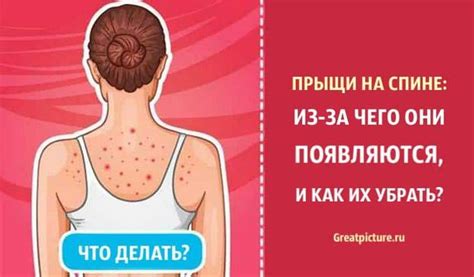Прыщи на спине: из-за чего они появляются и как их убрать? | Лечение ...
