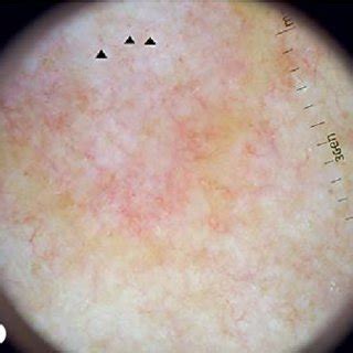 (PDF) Dermoscopy of Granuloma Annulare: A Clinical and Histological Correlation Study