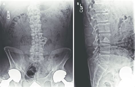 A Anterior Posterior Radiograph Demonstrating A Large Osteophyte