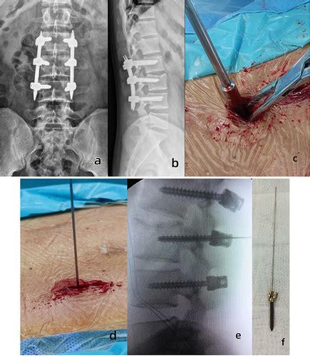 Full Article A Rapid And Safe Minimally Invasive Procedure For