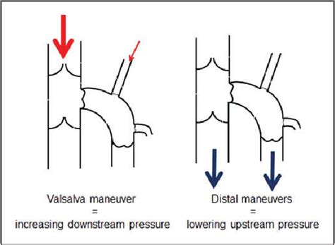 Valsalva Maneuver In Phlebologic Practice Semantic Scholar