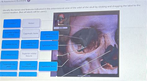 Solved 16 Assessment QuestionsIdentify The Bones And Chegg
