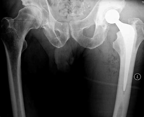 Cemented Total Hip Replacement Springerlink