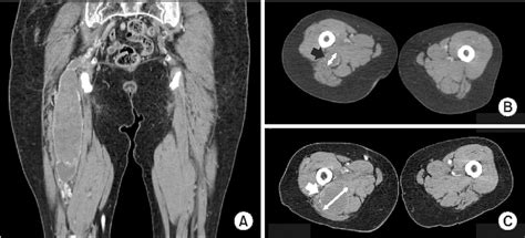 Figure 2 From Symptomatic Growth Of A Thrombosed Persistent Sciatic