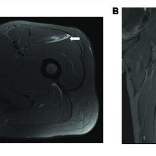 Tetra Polar L BIA Electrode Placement For Intramuscular Septum Rectus