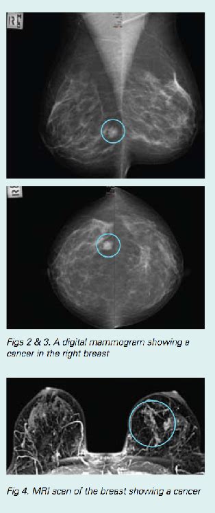 Managing Your Risk Of Breast And Ovarian Cancer Westmead Bci