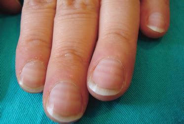 Transverse White Bands Are Clearly Visible On The Fingernails