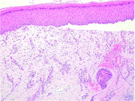 Histopathology Punch Biopsy Specimens Revealed A Paucicellular