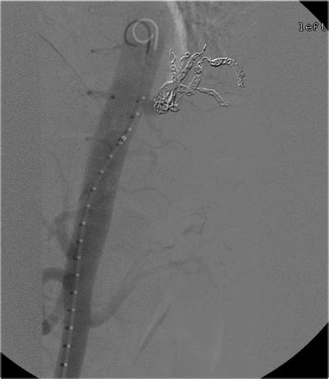 Dsa Of The Aorta Demonstrating Successful Embolization Of The Left