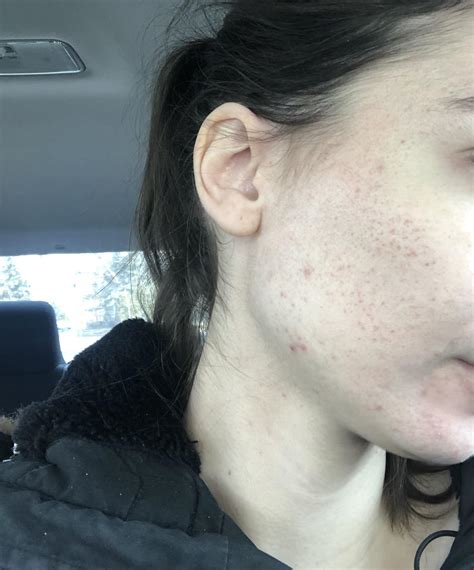 KP on face - nothing working : r/keratosis