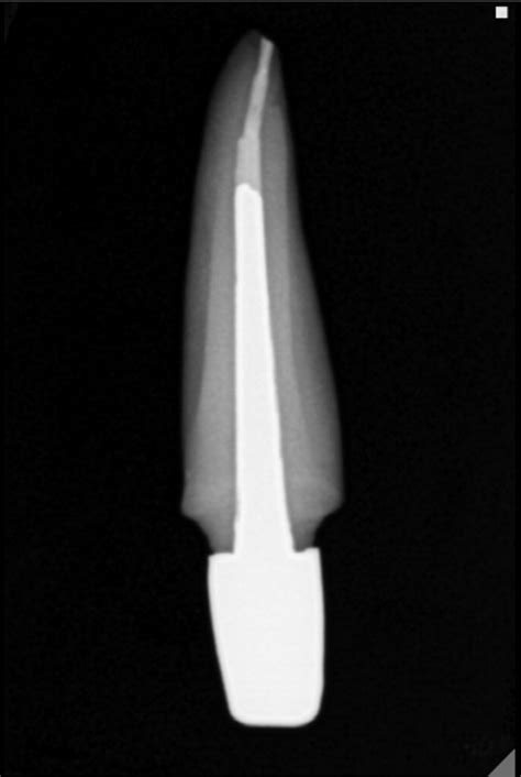 A Technique To Ensure The Reproducibility Of A Cast Post And Core Journal Of Prosthetic Dentistry