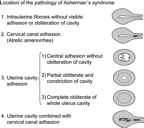 Asherman Syndrome—one Century Later Fertility And Sterility