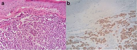 Histological Examination Showed A Merkel Cells Carcinoma MCC Marked