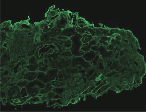 Figure From Lupus Podocytopathy Complicated With Multiple Organ