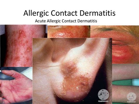 Allergic And Irritant Contact Dermatitis