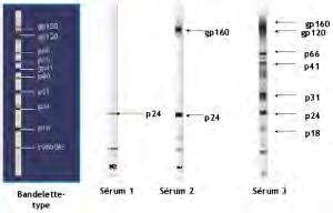 Diagnostic virologiques des hépatites virales B et C SFLS