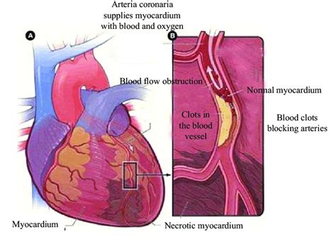 Pathophysiology Of Myocardial Infarction With Schematic Diagram | The ...