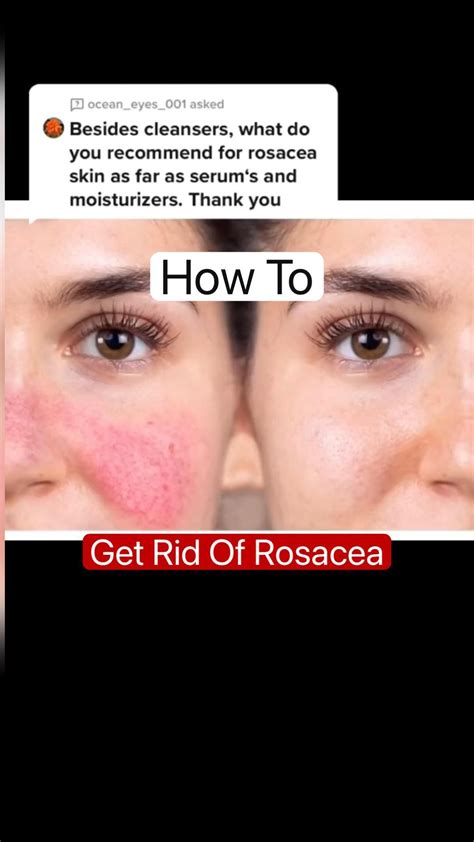 Rosacea causes triggers and skincare routine for rosacea – Artofit