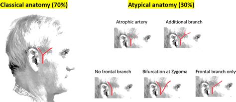 Temporal Artery Biopsy A Technical Guide And Review Of Its Importance And Indications Survey