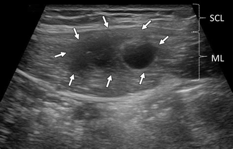 Atypical Sites Of Deeply Infiltrative Endometriosis Clinical Characteristics And Imaging