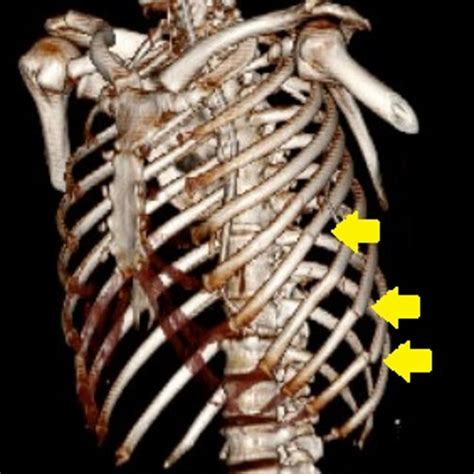 A 3D Reconstruction Of A Thoracic CT Scan Of A Blunt Chest Trauma Car