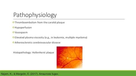 Amaurosis Fugax