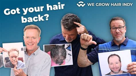 Get Your Hair Back At We Grow Hair Indy Years Of Hair Restoration