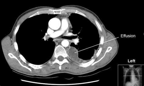 What Is The Difference Between Transudate And Exudate Pleural Effusion Pediaa