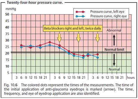 Glaucoma Examination Methods