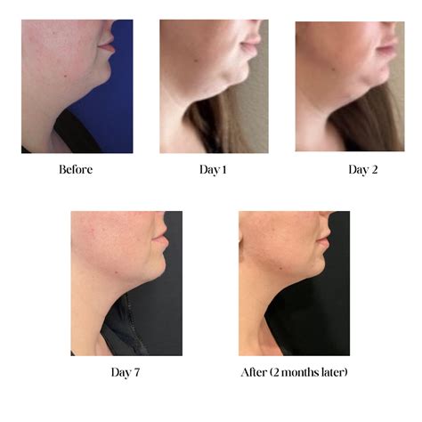 Kybella in St. Petersburg | Hermann Aesthetics