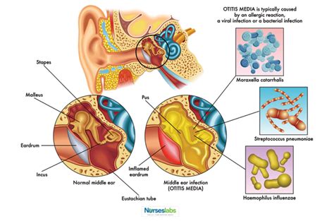 Otitis Media Nursing Care Planning And Management Study Guide