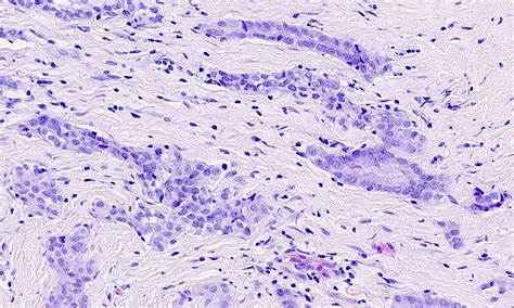 Epithelioid Mesothelioma Pathology Outlines - Goimages 411