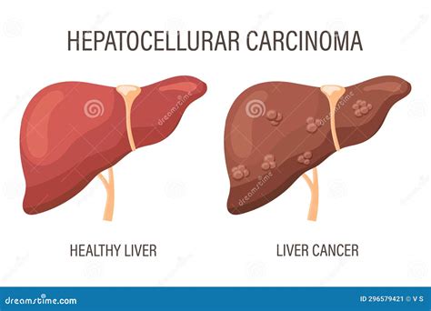 Hepatocellular Carcinoma Liver Diseases Healthy Liver And Liver