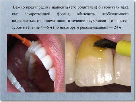 Фторсодержащие средства для местного применения при проведении ...