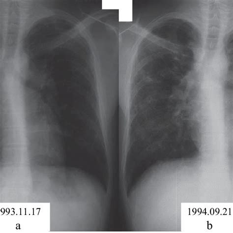 Chest CT films a. The wall of left bulla became thick. b. The wall of ...