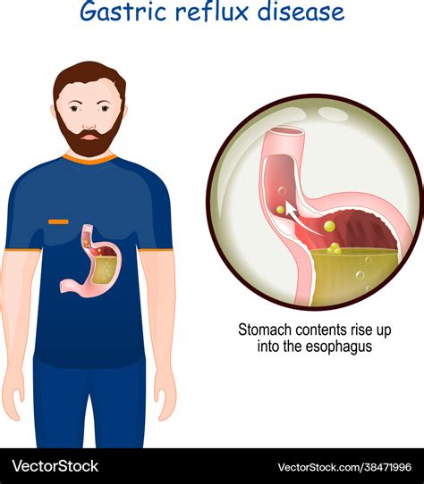 Gastroesophageal Reflux Disease Close Up Vector Image