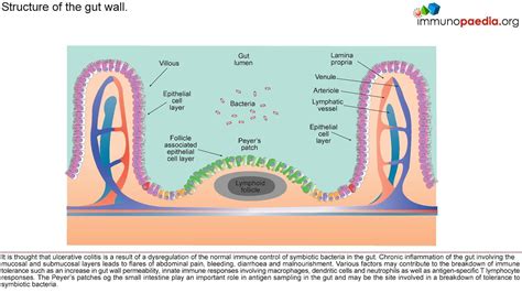 Pathophysiology Of Ulcerative Colitis