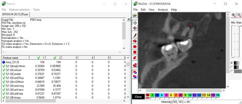 Differentiation Of Periapical Granuloma From Radicular Cyst Using Cone