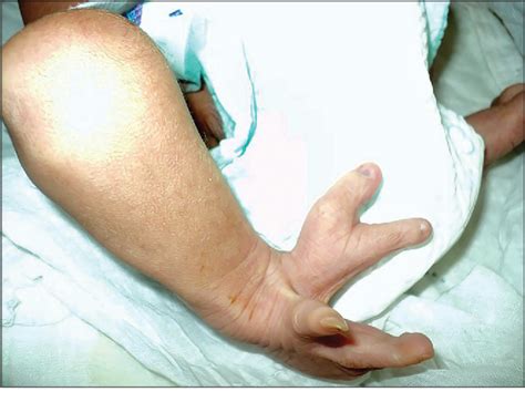 Figure 1 From A Case Of Ectrodactyly In A Neonate Semantic Scholar