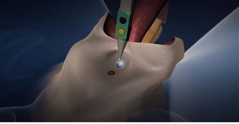 WATCH How Sex Change Surgery Is Done