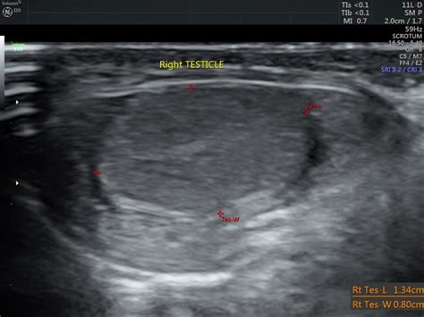 Spermatic Cord Hydrocele Looking Through A Transducer