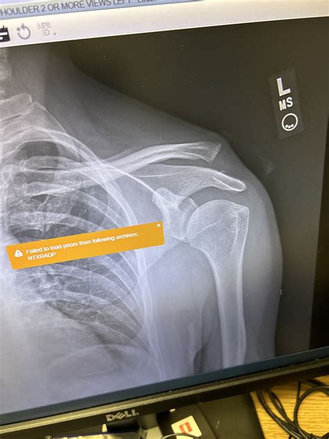 Clavicle re-location. Recovery tips? | Mountain Bike Reviews Forum