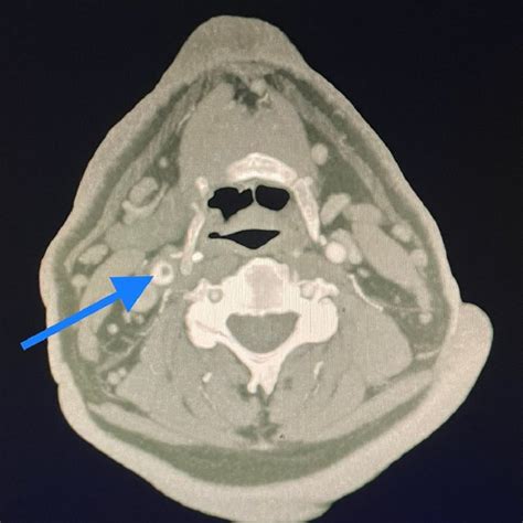 Axial View Computed Tomography Angiogram Cta Image Of The Carotid