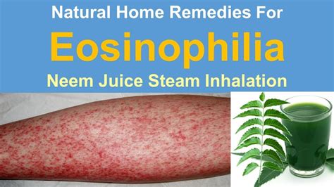 Natural Home Remedies For Eosinophilia - Get rid Eosinophilia with Neem ...