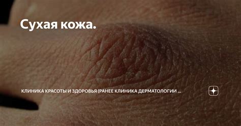 Сухая кожа. | Клиника дерматологии и косметологии Aderm | Дзен