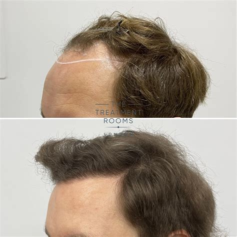 FUE Hair Transplant Result 2037 Grafts Treatment Rooms London