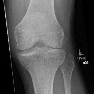 Anteroposterior AP Plain Film Weight Bearing WT Bearing Radiograph