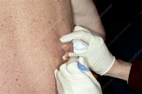 Sebaceous Cyst Drainage